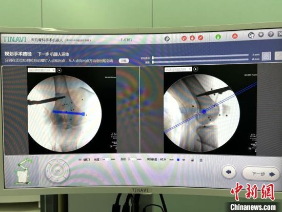 图为手术机器人规划手术路径展示画面。马何萍 摄 图为手术机器人规划手术路径展示画面。马何萍 摄